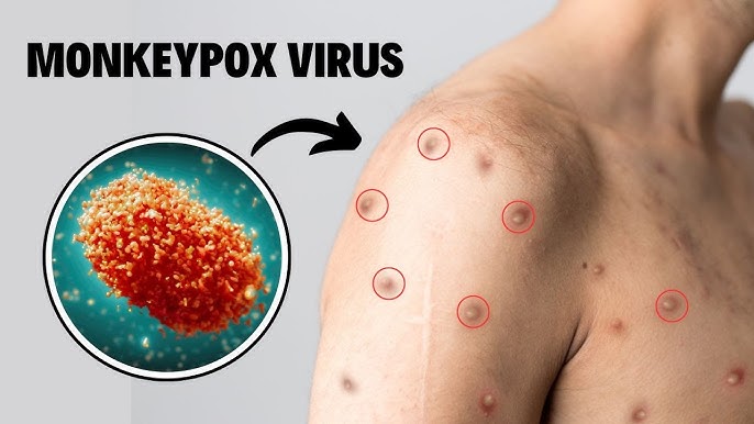Two more cases of potentially deadly mpox detected in UK | Ghana News ...