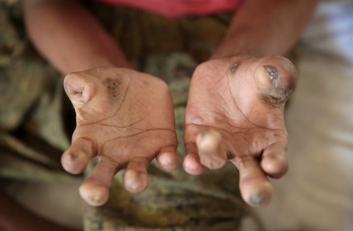 No case of Leprosy recorded at Manhyia hospital for over five years