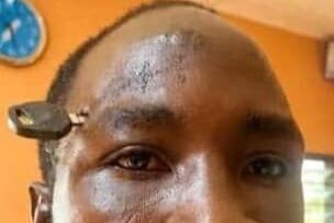 Doctors successfully remove motorbike key from farmer’s skull